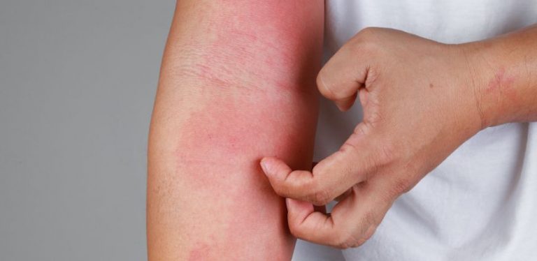 Scabies vs. Eczema