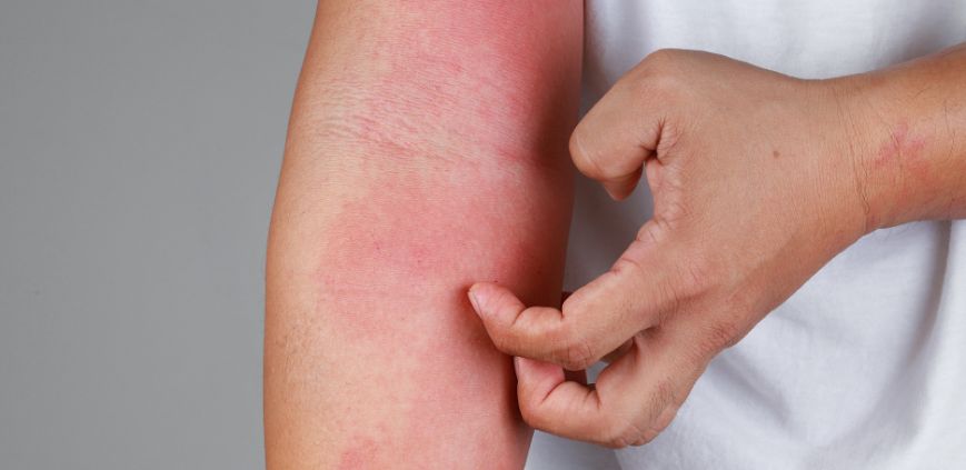 Scabies vs. Eczema