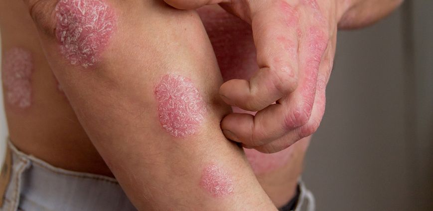 psoriasis triggers