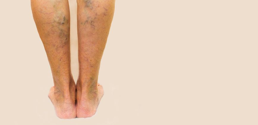 diet for varicose veins