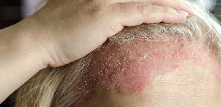 worst food triggers for eczema