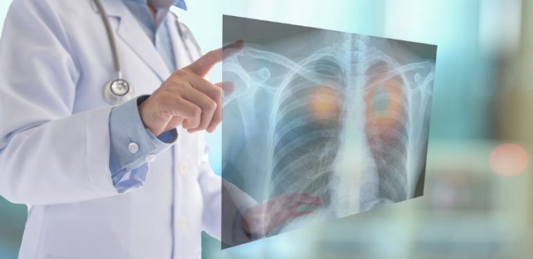 signs of lung cancer