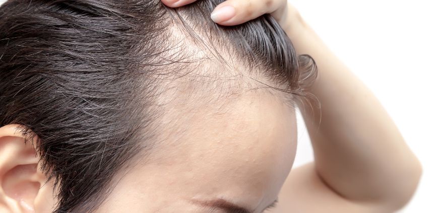 how to stop alopecia areata from spreading