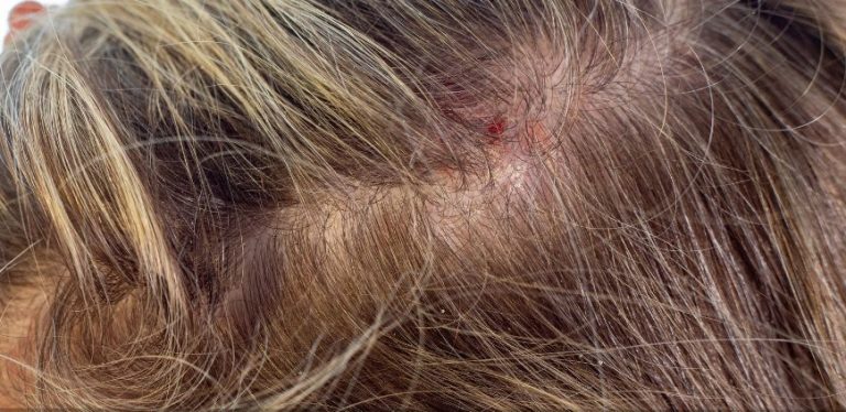 natural treatments for scalp psoriasis