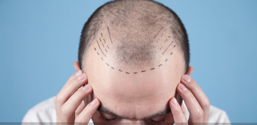 A man with lines drawn on his head for a hair transplant.